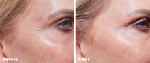 Load image into Gallery viewer, AnteAGE Home Microneedling System