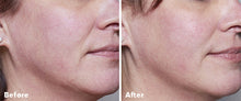 Load image into Gallery viewer, AnteAGE Home Microneedling System