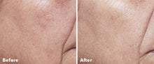Load image into Gallery viewer, AnteAGE Home Microneedling System
